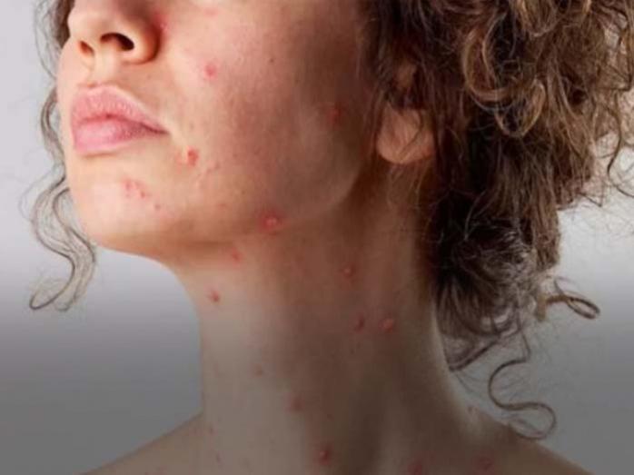  Waspadai, Ciri dan Gejala Awal Cacar Monyet